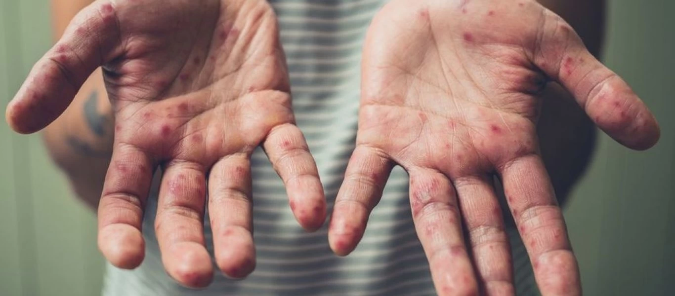 Δερματικά εξανθήματα και ποιες οι αιτίες τους